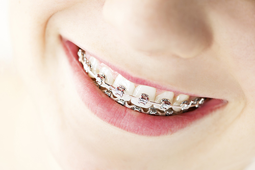 Kenosha Dental Braces