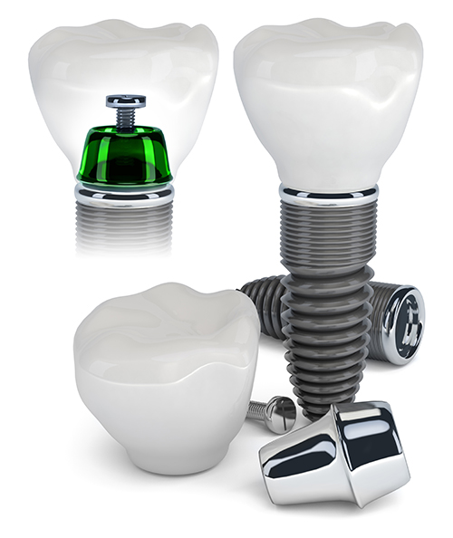 Kenosha Dental Implants