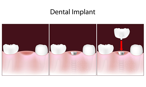 53142 Dental Implants