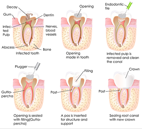 Root Canals in Kenosha