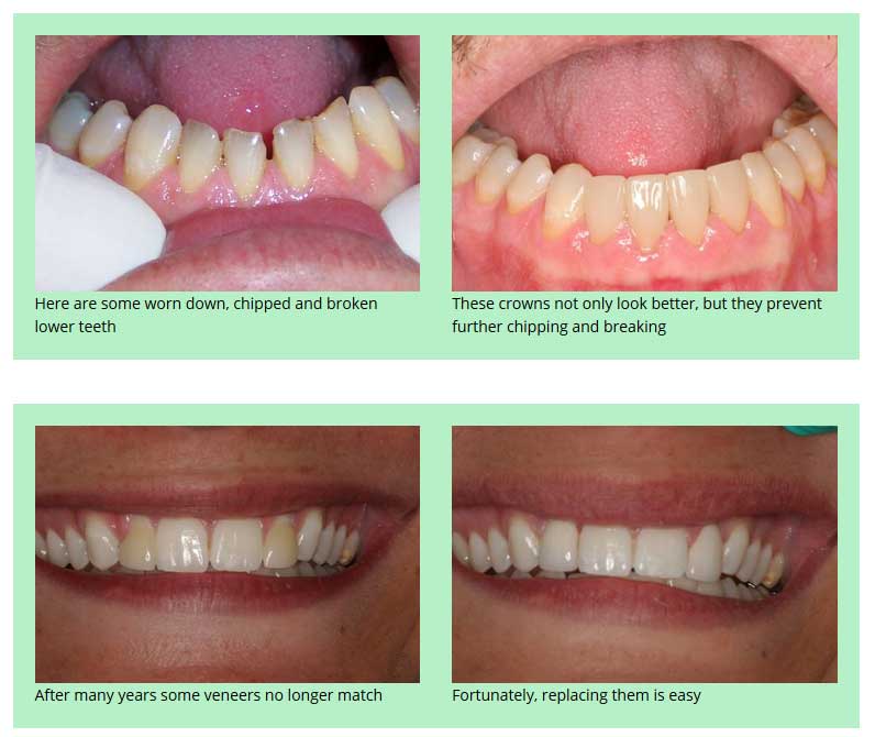Before and After Dental Implants in Kenosha